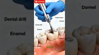 Wisdom Tooth Extraction Explained: Dental Procedure in 3D Visualization