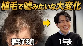 【植毛1年】絶望的だった薄毛はどうなった？この選択は正解だったのか...