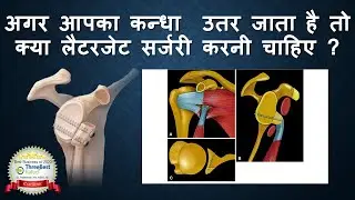 अगर आपका कन्धा  उतर जाता है तो क्या लैटरजेट सर्जरी करनी चाहिए ? Latarjet Surgery in Hindi