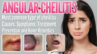 Angular Cheilitis Causes, Symptoms, Treatment, Prevention, and Home Remedies | Perleche, Stomatitis