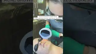 Clearer, Brighter Skin with IPL: Here&rsquo;s How It Works!