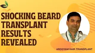Shocking Beard Transplant Results Revealed | Arogyam Guwahati