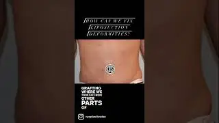 How do we fix botched liposuction?