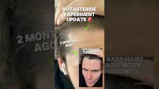 DUTASTERIDE HAIR GROWTH EXPERIMENT UPDATE! 🚨