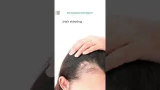 Hair Loss and PCOS