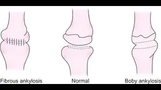 fibrous ankylosis; joint becomes stiff and immobile due to the formation of fibrous tissue