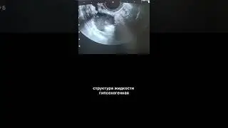 Зрелая тератома правого яичника #УЗИ