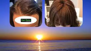 SOLUZIONI PER ALOPECIA DIRADAMENTO CAPELLI PROTESI CAPELLI HAIR LOSS INFOLTIMENTO
