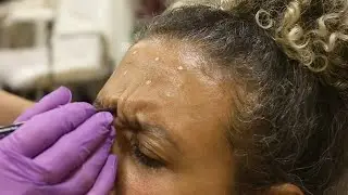 Vantagens da toxina botul&iacute;nica - Dra Cristina da Mata Age Laser 