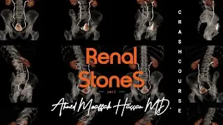 Nephrolithiasis Part -2 : Management of kidney stones