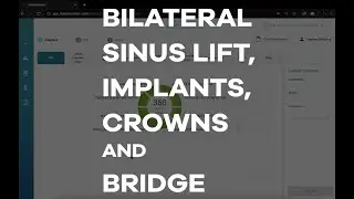 Presenting Sinus Lift, Implants, Crowns and Bridge using MakeMeClear Software