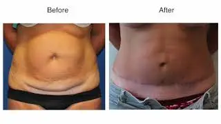 Tummy Tuck by Dr Damian Marucci