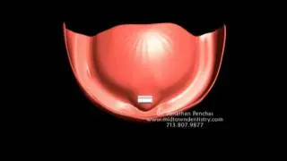What is a dental implant bar? - Houston Dentist