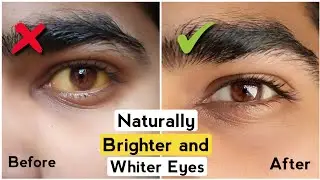 4 Tips to Get Brighter & Whiter Eyes |Get Rid of Yellow Eyes |White Eyes |How to have Attractive eye