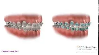 Ceramic Brackets - Braces