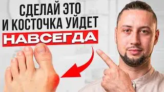 Косточка на стопе растёт из-за ЭТОГО! 90% людей не знают причину