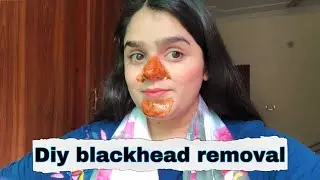 How to remove blackheads at home || Diy blackhead removal