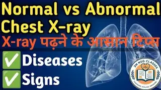 Normal V/s Abnormal Chest X-ray | x-ray समझे आसान तरीके से | Chest X-ray Disease & Clinical Sign 