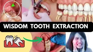 ❓ Wisdom Tooth Pain Relief 🥹 | Wisdom Tooth Extraction/Removal #DentistMummaHindi