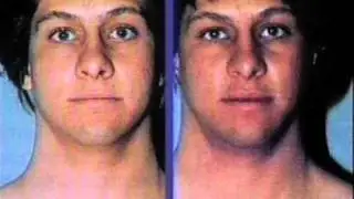 Melanotan (one) 