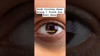 Dark Circles Gone Wrong | Truth You Must Know