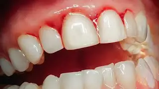 Causes of Gum Recession | How to Reverse Gum Recession Naturally