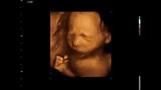 23 Week Old Baby - 3D 4D Ultrasound New Jersey