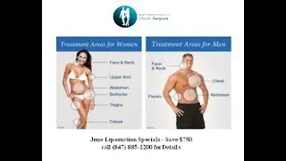 liposuction Surgery Schaumburg IL | Call (847) 885-1200