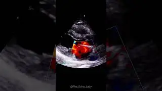 Rheumatic mitral valve! 🫣 #cardiology #echocardiogram #echocardiography