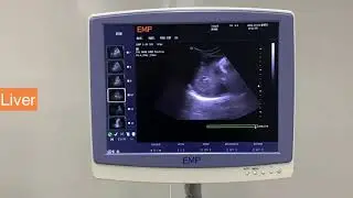 EMP-3000 Ultrasound Machine Clinical Video  Узи аппарат видео клинических исследований