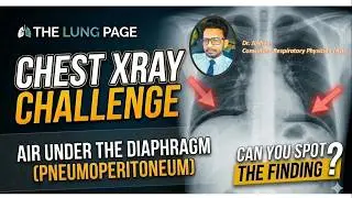 Chest X-ray Challenge - 11 - Air Under the Diaphragm