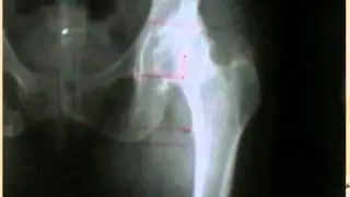 PROF. GRAPPIOLO, RESPONSABILE CHIRURGIA PROTESICA ANCA E GINOCCHIO - HUMANITAS GAVAZZENI (PARTE 1)