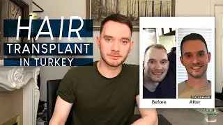 Hair Transplant in Turkey | Review on my experience with Clinic Center