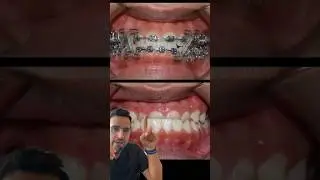 Cas ORTHODONTIE : l&rsquo;INVERS&Eacute; d&rsquo;occlusion DENTAIRE