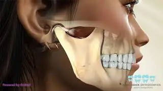 TMJ splint