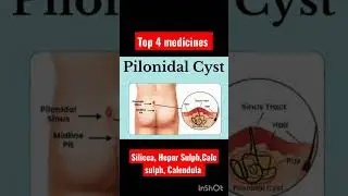 Pilonidal cyst, top 4 Homeopathic Medicines #clinicaltips #homeopathicmedicine #trendingshorts