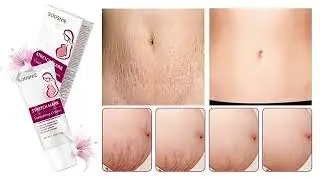 Stretch Mark Vanishing Cream Repair Anti-Wrinkle Anti-Aging Pregnant Women Stretch Marks Treatment