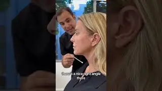 Neck and Face lift Results | Beverly Hills | Newport Beach | Dr. Ardesh