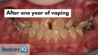 Why vaping destroys your mouth