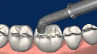 Universal adhesive Futurabond U-Part 8/12: Sealing of cavities prior to amalgam restorations