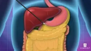 Gastric Sleeve 3D version - LIMARP/DR LIZA POMPA