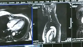 SCAD - Spontaneous Coronary Artery Dissection
