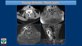 TIPIC syndrome