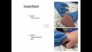 IV cannulation for novices - The Pop/Stop/Drop technique