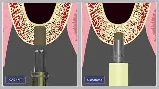 CAS Drill vs Osteotome
