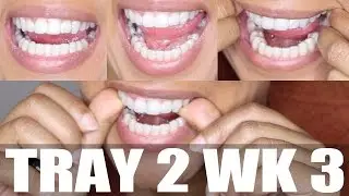 WK 3 (Clear Braces): Tray 1 Update + Tray 2 Try-on | SmileDirectClub | Kyma Monai