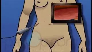 Anti Reflux Laparoscopy Surgery • PreOp Patient Education • Patient Engagement