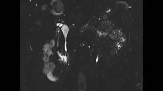 Choledochal cyst with APBJ