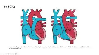 Transposition of the Great Arteries