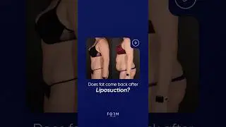 Does Fat Come Back After Liposuction?